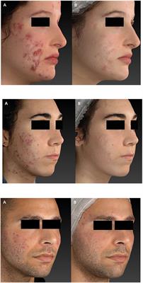 Effective Intense Pulsed Light Protocol in the Treatment of Moderate to Severe Acne Vulgaris